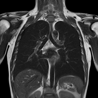 mri-magnetom-spectra-clinical-thorax-00130493_8