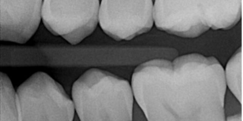 A bitewing intraoral radiograph.