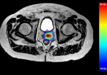 unity-monaco-prostate-dose-axial-view